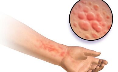 Manifestations of schistosomiasis in humans